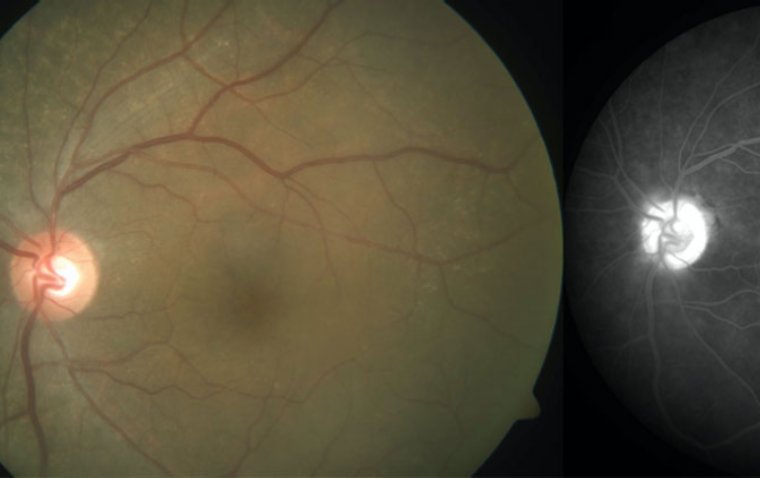 Внутриглазные кортикостероиды признаны оптимальным методом лечения увеитного макулярного отека