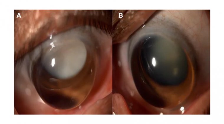 Интумесцентная катаракта: клиническая характеристика и подходы к лечению