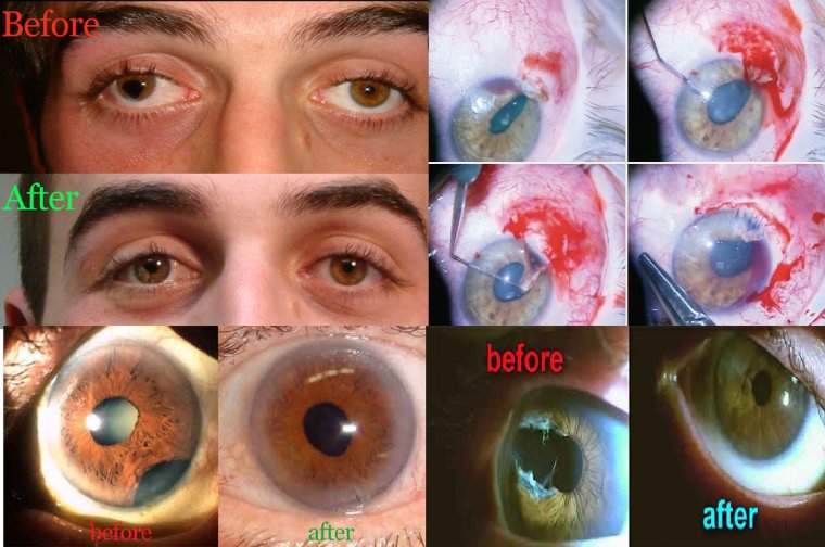 Реконструкция радужной оболочки при травмах: методы хирургической коррекции