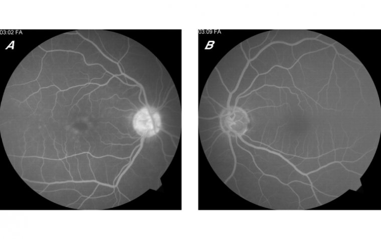 Синдром Ирвина-Гасса: Этиопатогенез, Клиническая Картина и Терапевтические Подходы
