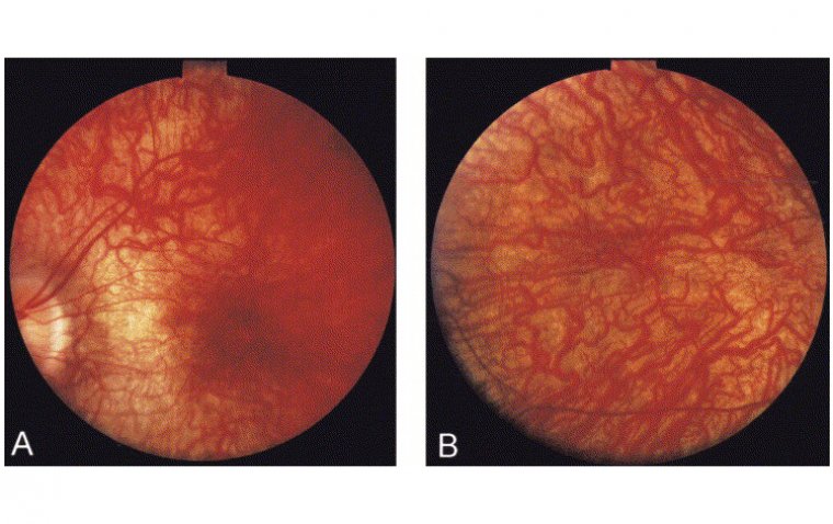 Врожденный амавроз Лебера: клиническая картина наследственной дистрофии сетчатки