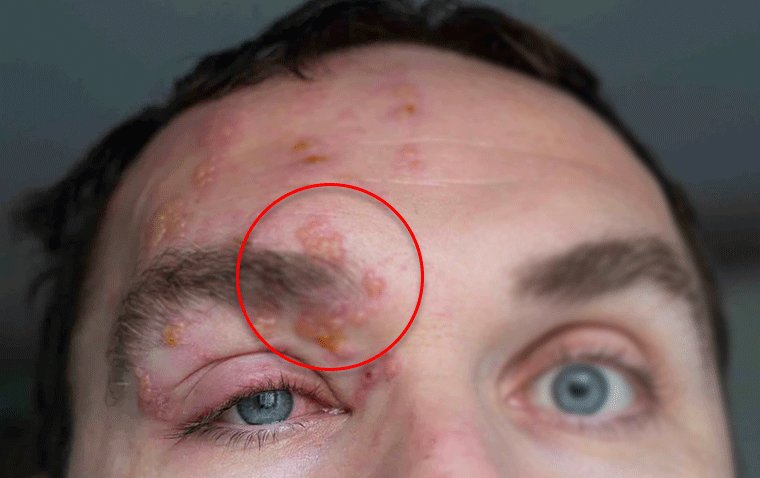 Долгосрочная противовирусная терапия — ключевой фактор профилактики потери зрения при офтальмогерпесе