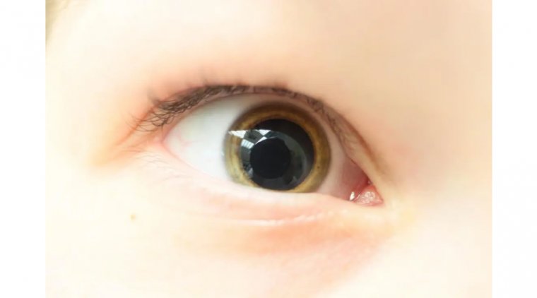 Мидриаз: Этиология, Клиническая Картина и Терапевтические Подходы