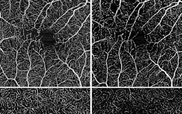 Новый метод визуализации для мониторинга и прогнозирования течения увеита