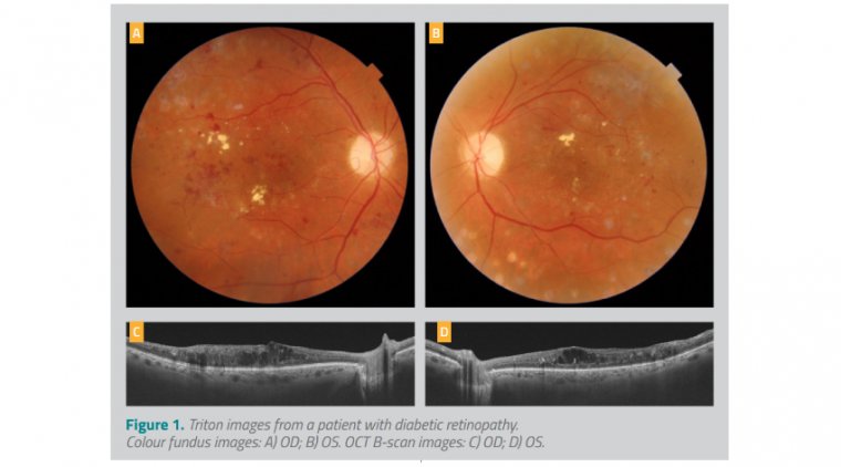 Оптическая когерентная томография в мультимодальном формате: эволюция клинической эффективности