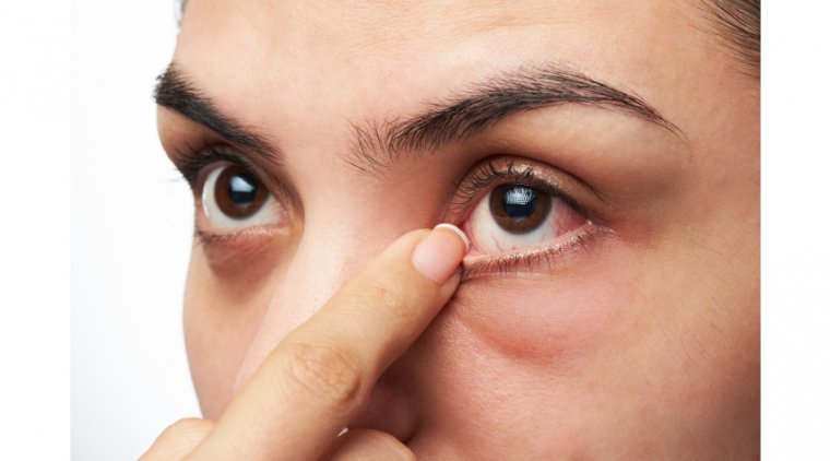 Трехнедельный курс азитромицина сопоставим по эффективности с шестинедельным курсом доксициклина при дисфункции мейбомиевых желез