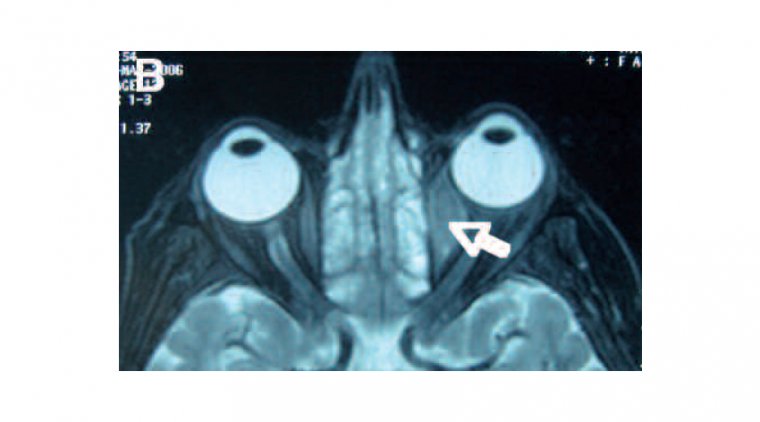 Орбитальная лимфома: клиническая картина, этиология и терапевтические подходы