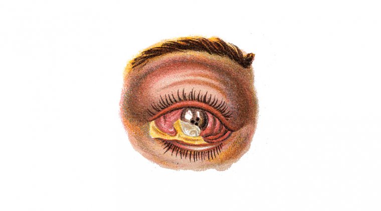 Панофтальмит: тяжелая внутриглазная инфекция, угрожающая зрению