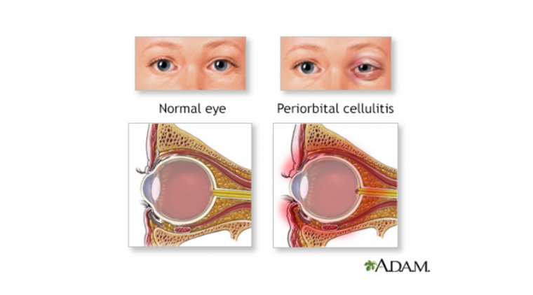 Периорбитальный целлюлит: ключевая роль антибиотиков в терапевтическом протоколе