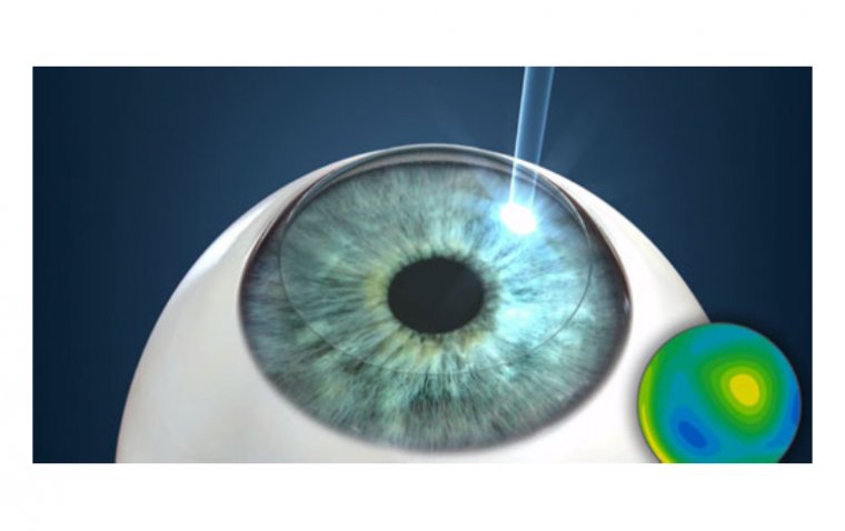 Фототерапевтическая кератэктомия: клиническое руководство по лазерному лечению заболеваний роговицы