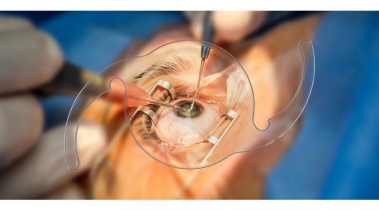 Интраокулярная линза: анализ преимуществ и ограничений хирургической имплантации