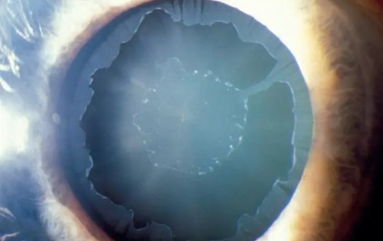 Синдром псевдоэксфолиации: этиология, диагностика и терапевтические подходы