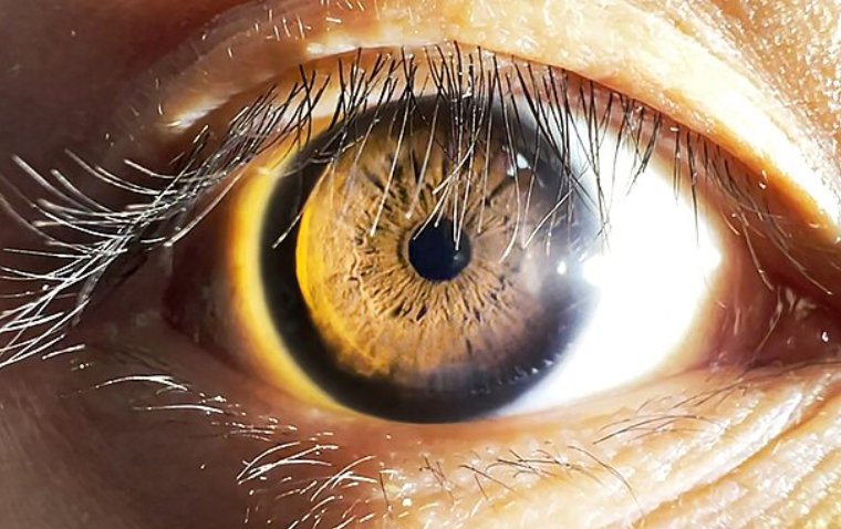 Миоз: патофизиологическое сужение зрачка и принципы терапевтической коррекции