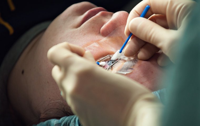 Радиальная кератотомия: подробный анализ метода коррекции миопии