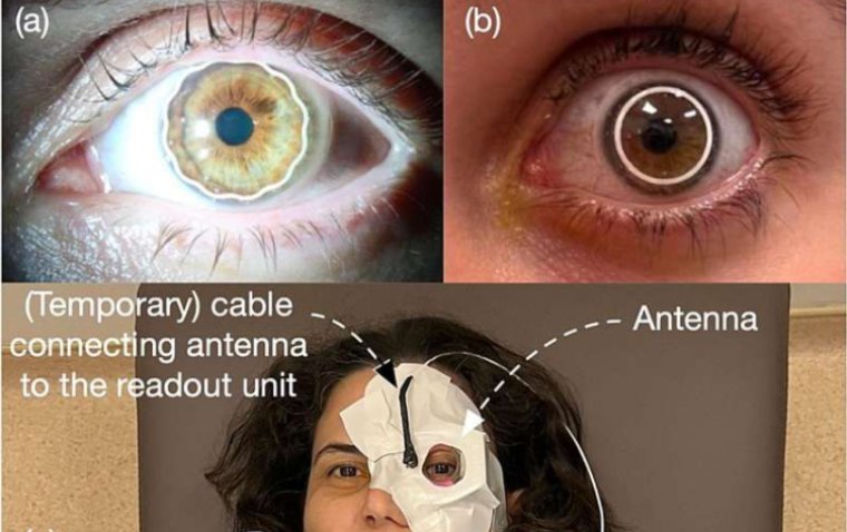 В Великобритании и Турции разработана контактная линза для раннего выявления глаукомы