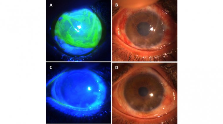 Трансплантация лимбальных стволовых клеток: принципы, типы и прогноз восстановления зрения