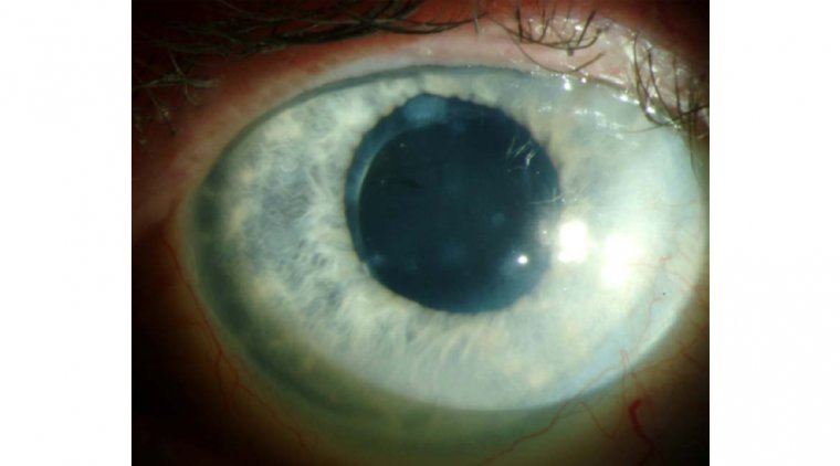 Диагностика и лечение узловой дегенерации Зальцмана: обзор методов