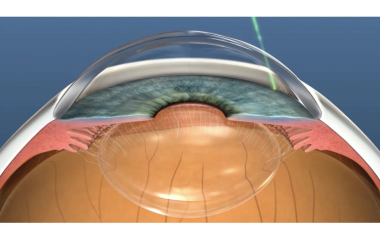 Селективная лазерная трабекулопластика (СЛТ) в лечении глаукомы: анализ метода