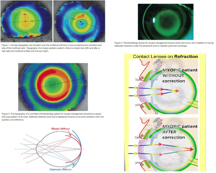 Контактные линзы в терапии прогрессирующей миопии у детей: обзор методов и клинических данных