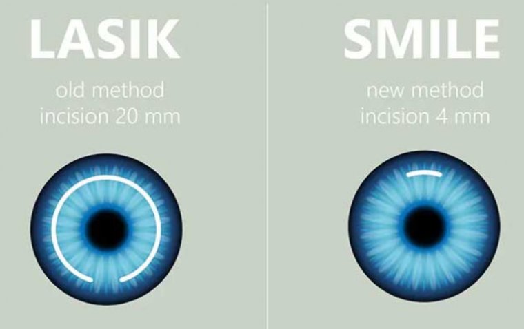 Сравнение рефракционных методик: LASIK и SMILE – анализ подходов для коррекции зрения