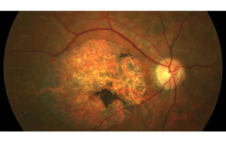 Болезнь Штаргардта: клиническая картина, диагностика и современные подходы к ведению пациентов