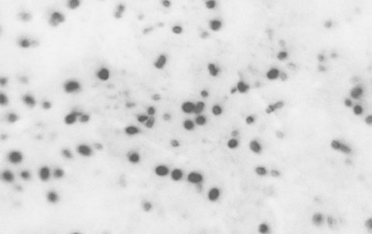 Эмпирическая антибиотикотерапия при конъюнктивите у детей: анализ отклонений от клинических рекомендаций