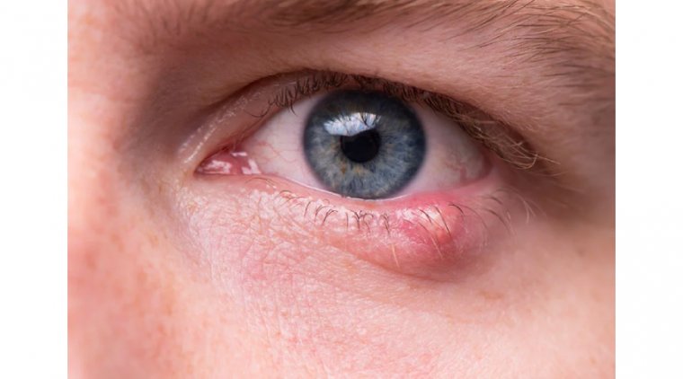 Ячмень на глазу: этиология, клиническая картина и терапевтические подходы