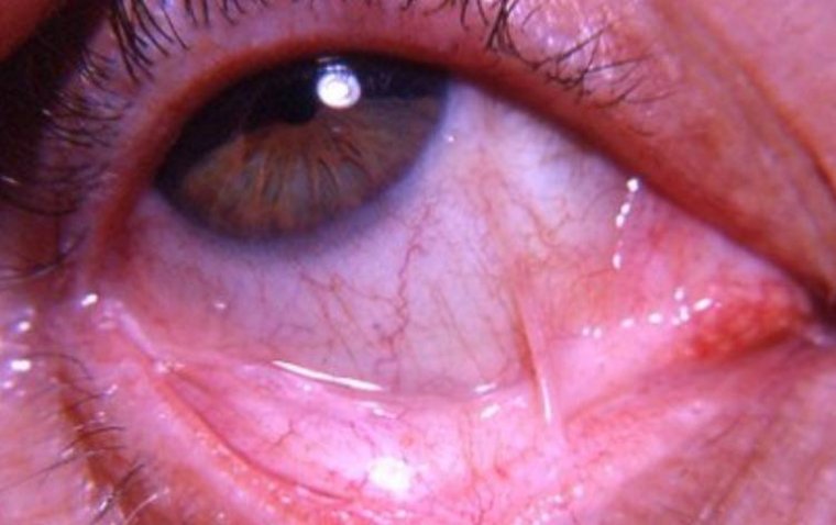 Симблефарон: сращение конъюнктивы и роговицы как угроза зрению