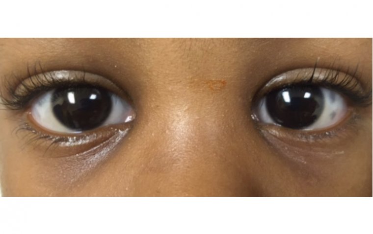 Склеральный меланоцитоз: клиническая характеристика и подходы к терапии