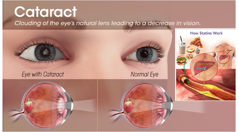 Влияние статинов на риск развития катаракты: данные мета-анализа