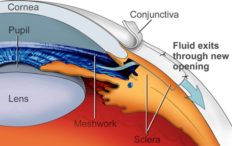 Трабекулэктомия: комплексное руководство по хирургическому лечению глаукомы