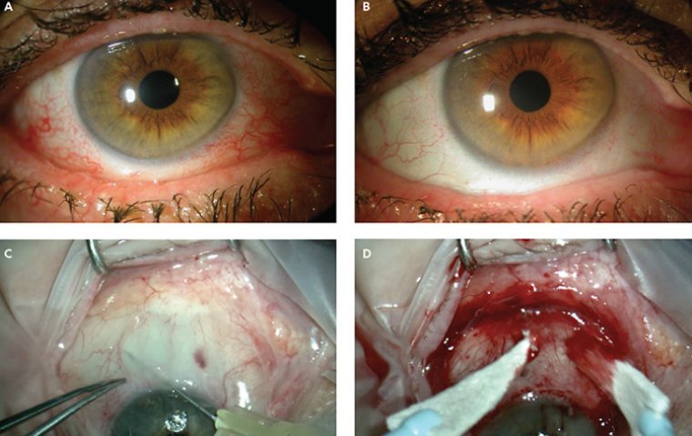 Хирургическое лечение конъюнктивохалазиса: обзор методов и тактика ведения пациентов
