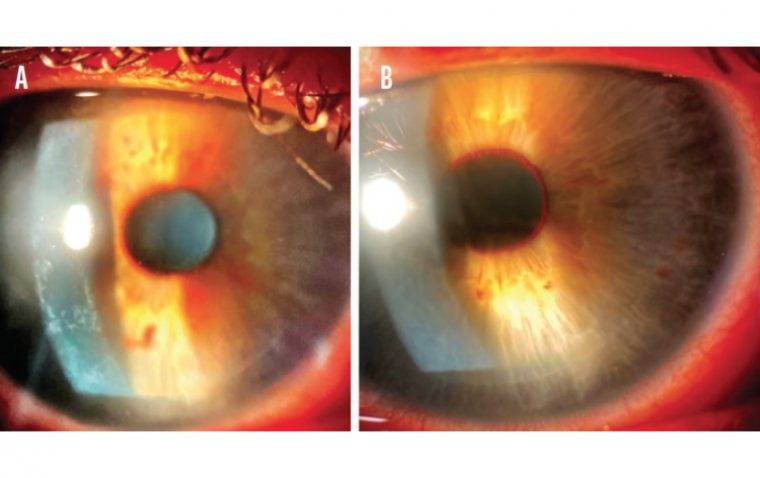 Диффузный ламеллярный кератит после LASIK: клиническая картина и терапевтическая тактика