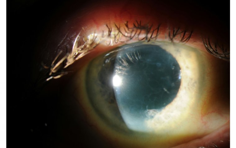 Эпителиальная базальная мембранная дистрофия: этиология, клиническая картина и подходы к ведению