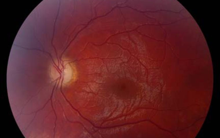 Наследственная оптическая нейропатия Лебера (НОНЛ): патогенез, диагностика и терапевтические подходы