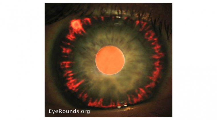 Синдром пигментной дисперсии: клиническая картина, факторы риска и подходы к лечению