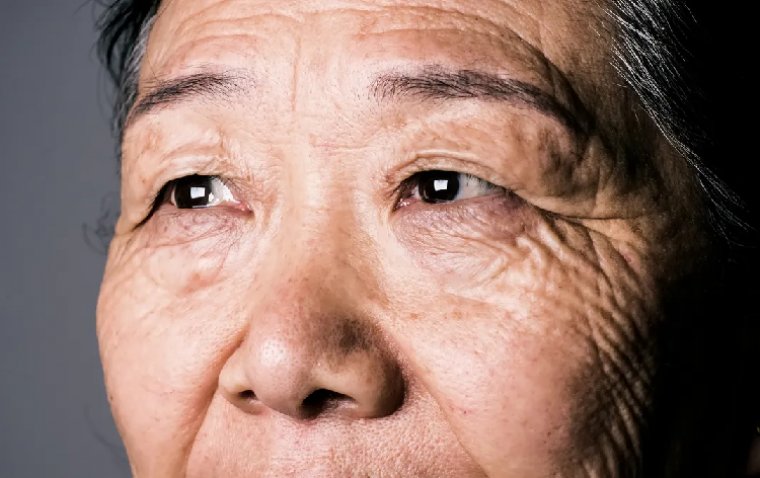 Применение ингибиторов VEGF при неоваскулярной ВМД связано со снижением смертности