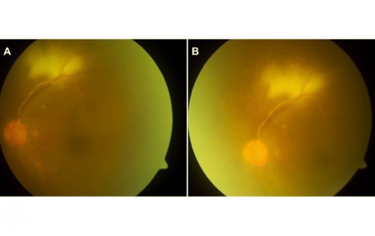 Витреит: этиология, клиническая картина, диагностика и терапевтическая тактика