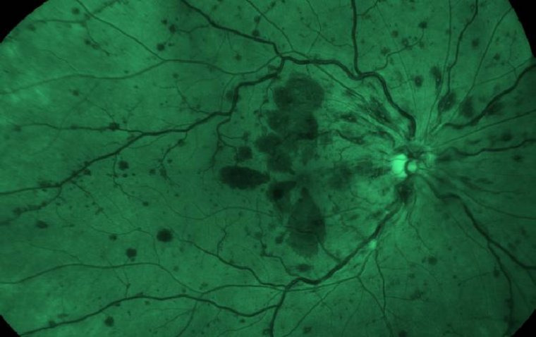 Университет Уэйна получил грант на изучение влияния диабета на роговицу