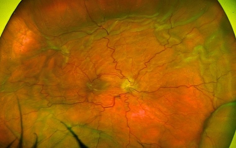 Офтальмологический анализ гипотонии глаза: причины, симптомы и тактика ведения пациентов