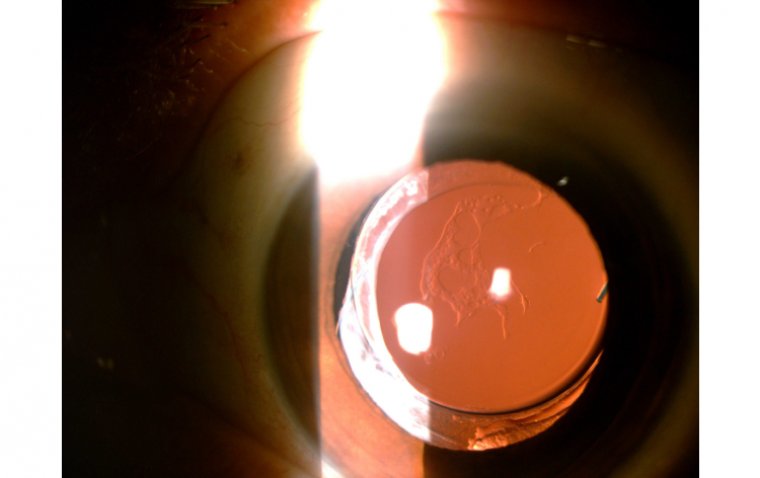 Задняя капсулярная помутнение: причины, диагностика и современные методы лечения