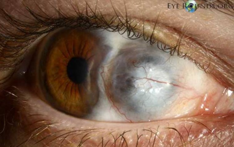 Стакфилома: этиология, клиническая картина и подходы к лечению