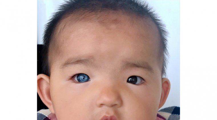 Синдром Ваарденбурга: этиология, классификация, клиническая картина и диагностика