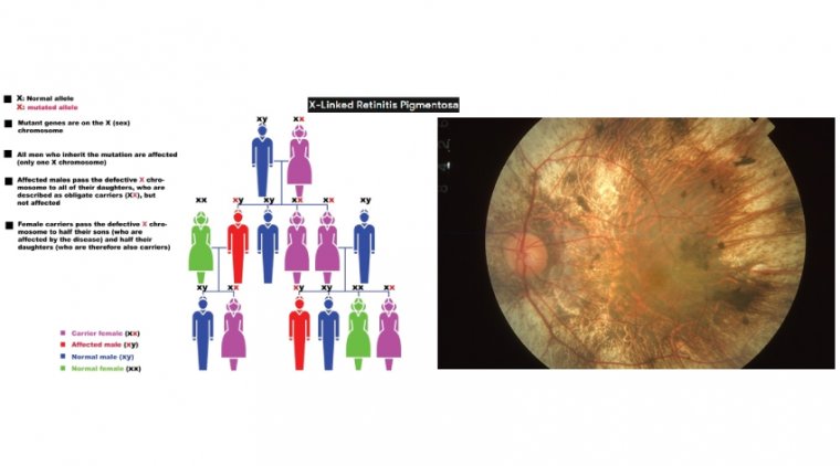 Сцепленное с X-хромосомой наследственное заболевание сетчатки: клиническая картина и бремя X-сцепленного пигментного ретинита