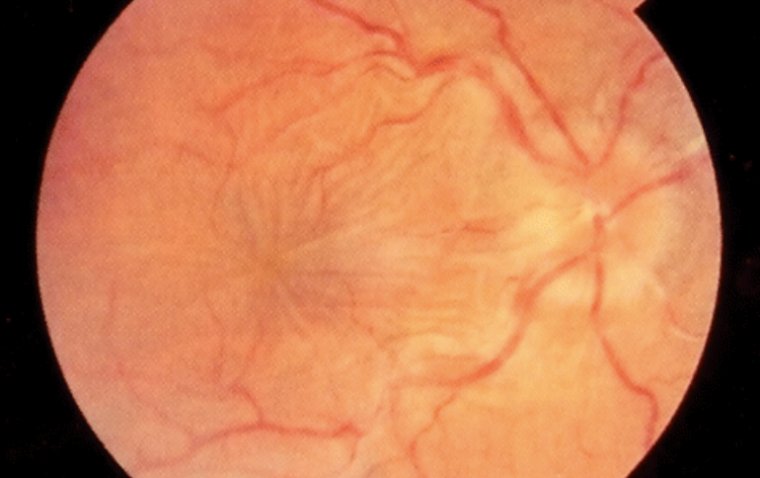 Гипотоническая макулопатия: диагностика и терапевтические подходы при снижении внутриглазного давления