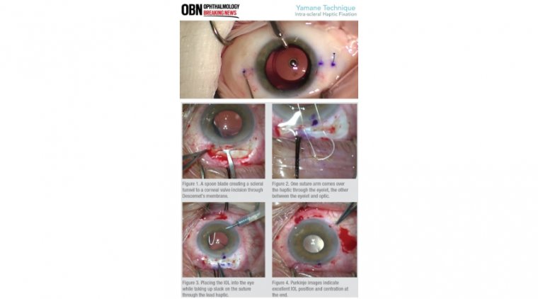 Бесшовная интрасклеральная фиксация ИОЛ: анализ методики Ямане