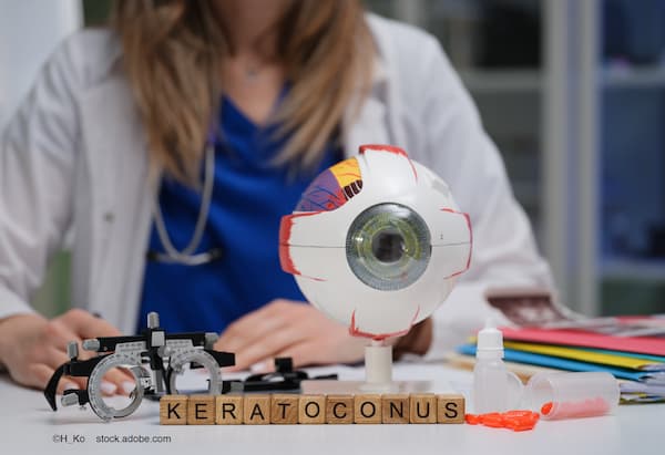 Препарат Epioxa компании Glaukos для лечения кератоконуса получил постоянный J-код, вступающий в силу с 1 июля 2026 года