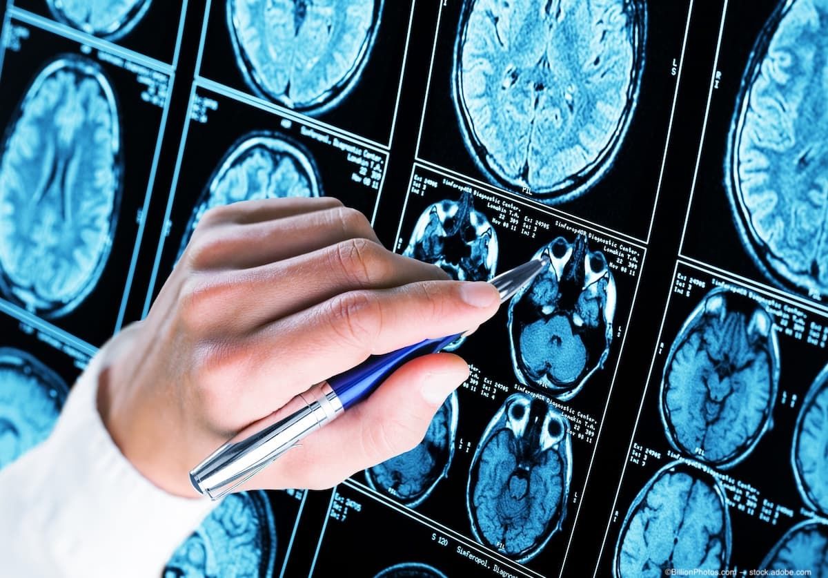 Потенциальный новый метод визуализации для быстрой дифференциации сходных нейродегенеративных заболеваний