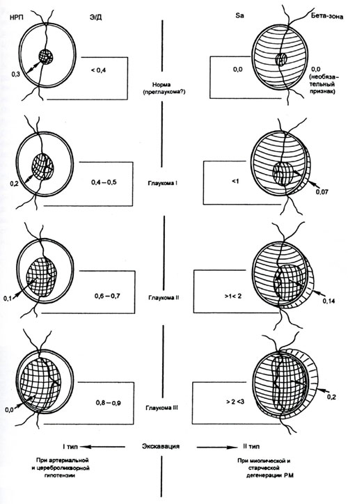Волков - Рис.1. Схема оценки стадии глаукомы в зависимости от офтальмоскопически определяемой площади (Sа) и атрофической экскавации ДЗН (1-го и 2-го типов)