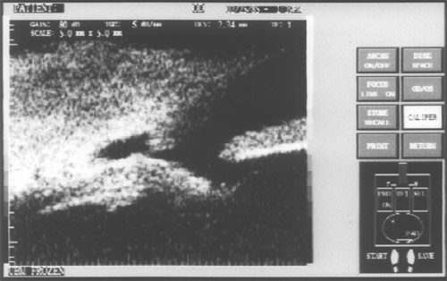 Алексеев И.Б. Рис. 4. Ультразвуковая биомикроскопия зоны операции в ранние сроки после операции.